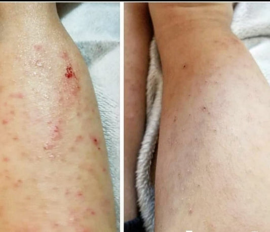 Eczema baby care guide before after all natural cure