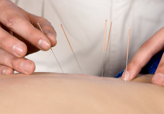 acupuncture St albert Service